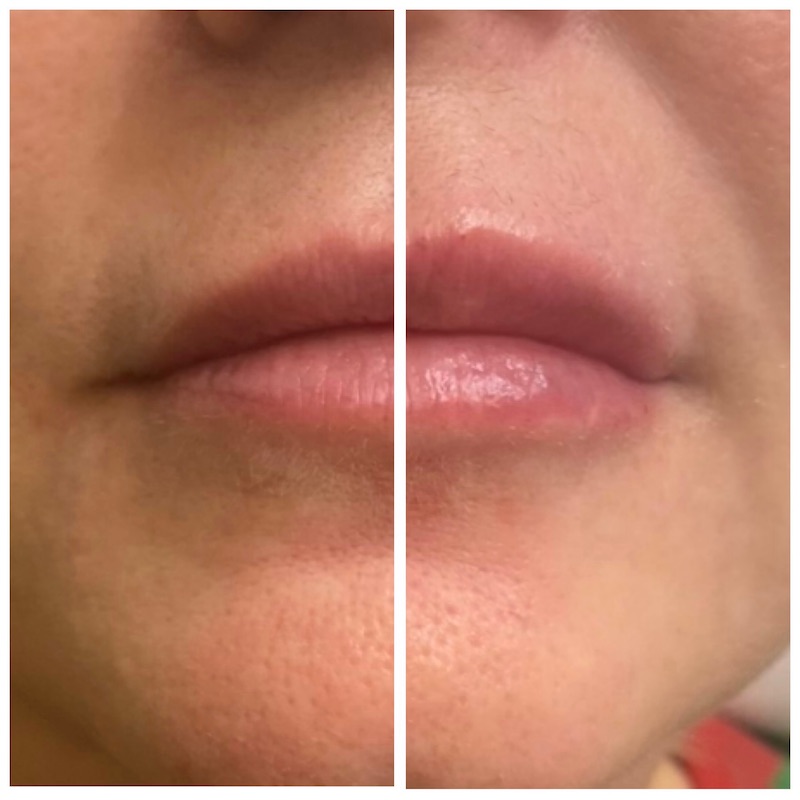 lip botox injection before and after woman lip treatment before after botox injection