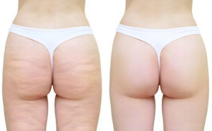before and after liposuction examples
