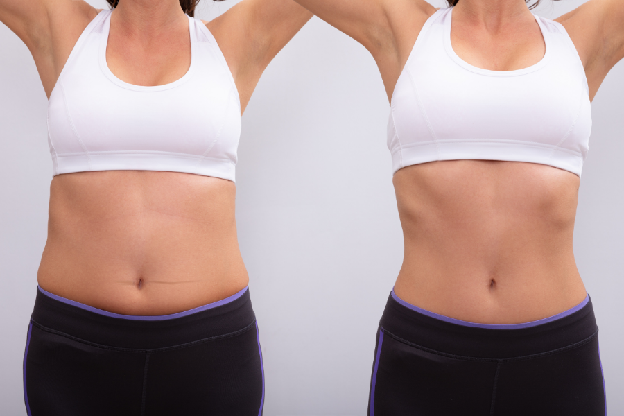 before after liposuction tummy md touch