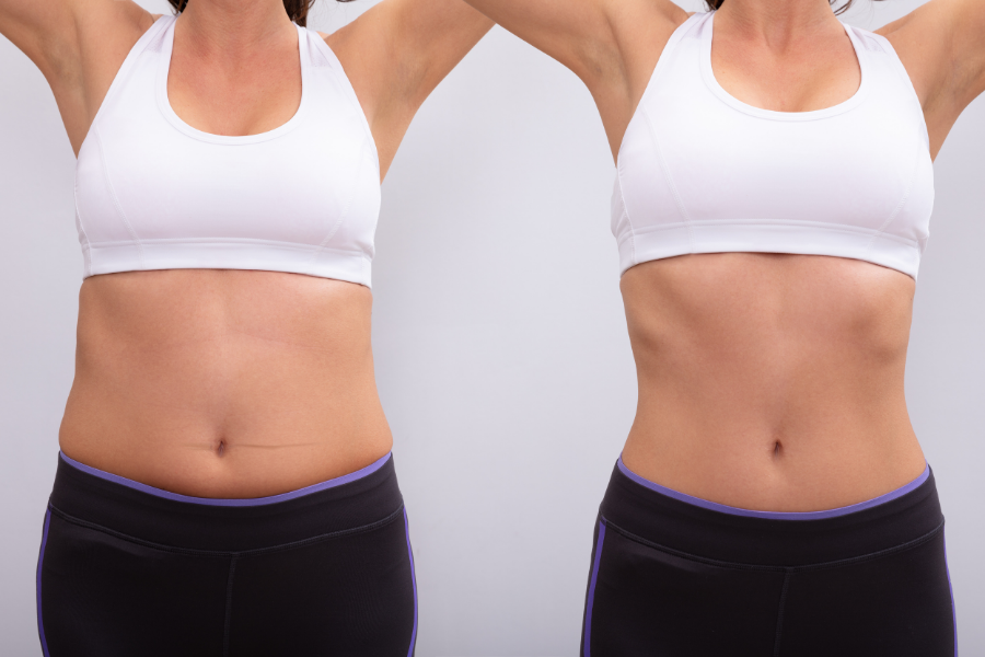 Dr. Sandra McGill - Liposuction can improve your silhouette in