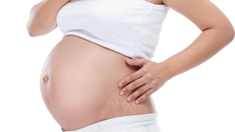 stretch mark pregnancy