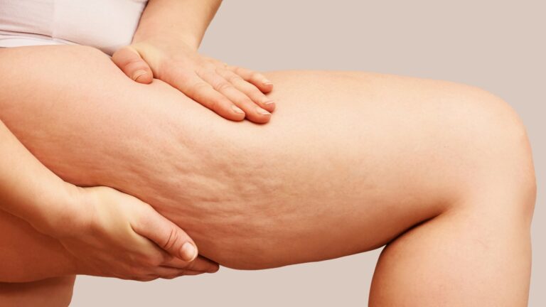 Cellulite treatment | Cellulite Treatment