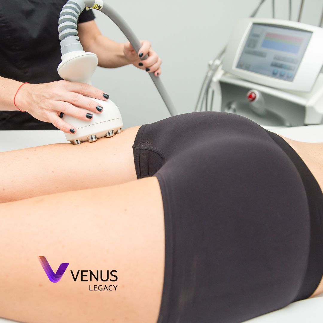 Venus Legacy technology treatment at MD Touch Aesthetics and Wellness in Coral Springs Florida