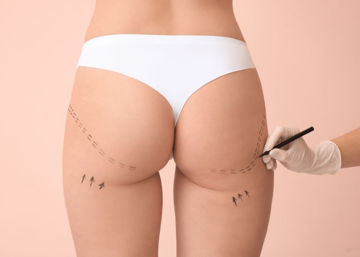 Liposuction