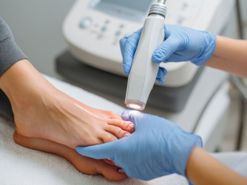 Fungal Laser Treatment