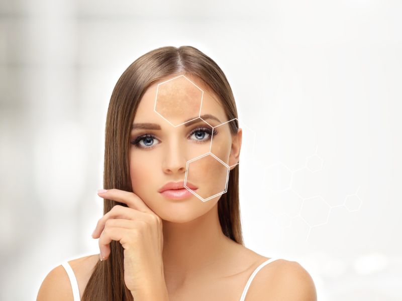 Melasma Laser Treatment