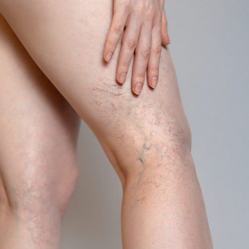 spider veins example legs md touch